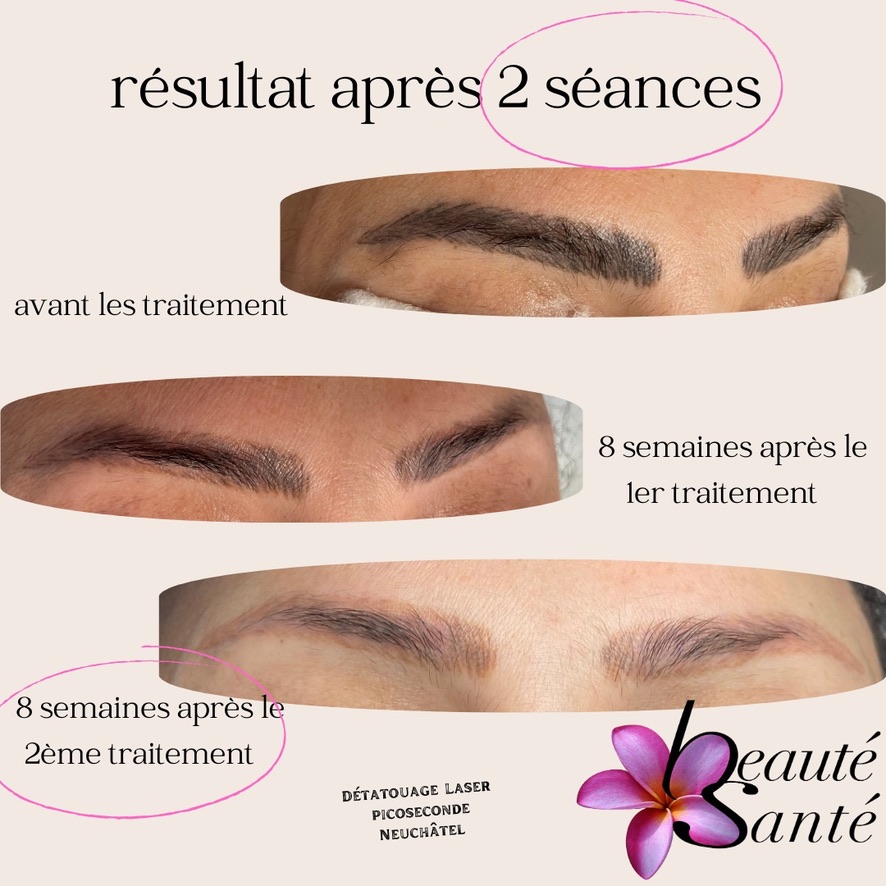 2 séances sourcila - 1